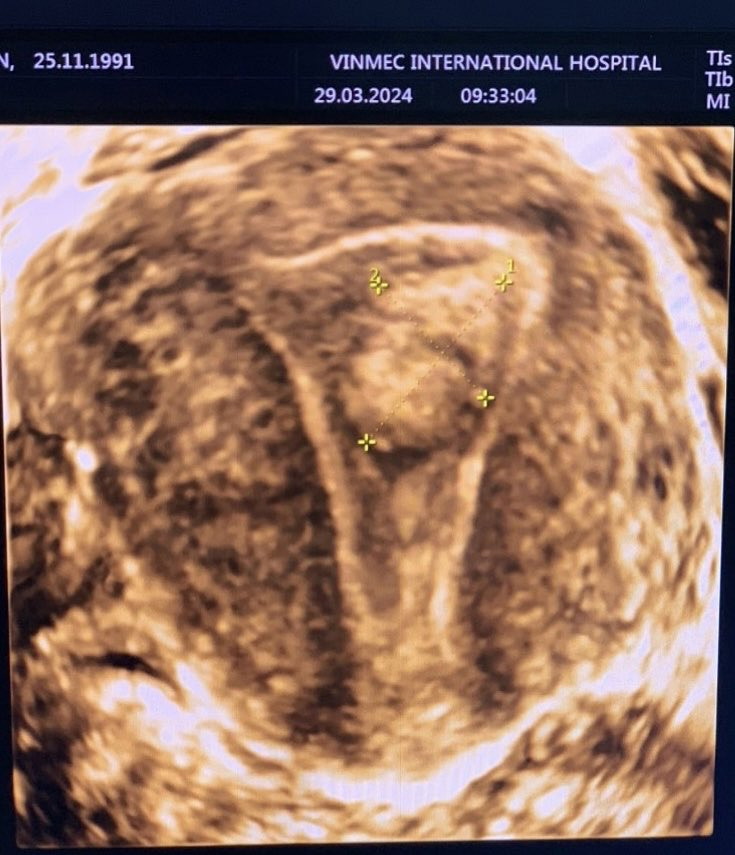 Đi khám tiền hôn nhân phát hiện hiếm muộn, người phụ nữ nhất quyết làm IVF nhưng BS nói đây mới là điều đầu tiên nên làm để tìm con- Ảnh 1.