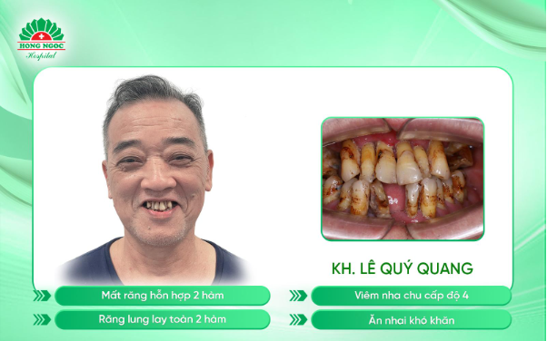 U70 hạnh phúc khi tìm lại niềm vui trọn vẹn trong từng bữa cơm nhà sau trồng răng Implant- Ảnh 1. U70 hạnh phúc khi tìm lại niềm vui trọn vẹn trong từng bữa cơm nhà sau trồng răng Implant- Ảnh 1.
