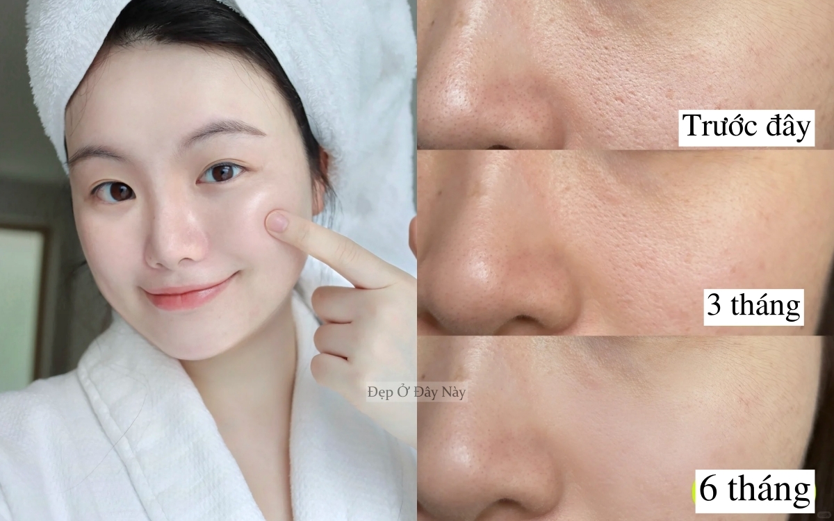 Ở tuổi 27 tuổi, tôi "biến" lỗ chân lông từ to tới mịn mướt như gương nhờ 6 tháng dưỡng da kiên trì- Ảnh 1. Ở tuổi 27 tuổi, tôi "biến" lỗ chân lông từ to tới mịn mướt như gương nhờ 6 tháng dưỡng da kiên trì- Ảnh 1.