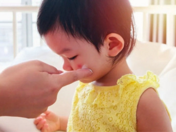 Ngày càng nhiều trẻ bị tác dụng phụ do dùng thuốc chứa corticoid: Dược sĩ chỉ rõ cách nhận biết corticoid trong đơn thuốc của con- Ảnh 3. Ngày càng nhiều trẻ bị tác dụng phụ do dùng thuốc chứa corticoid: Dược sĩ chỉ rõ cách nhận biết corticoid trong đơn thuốc của con- Ảnh 3.