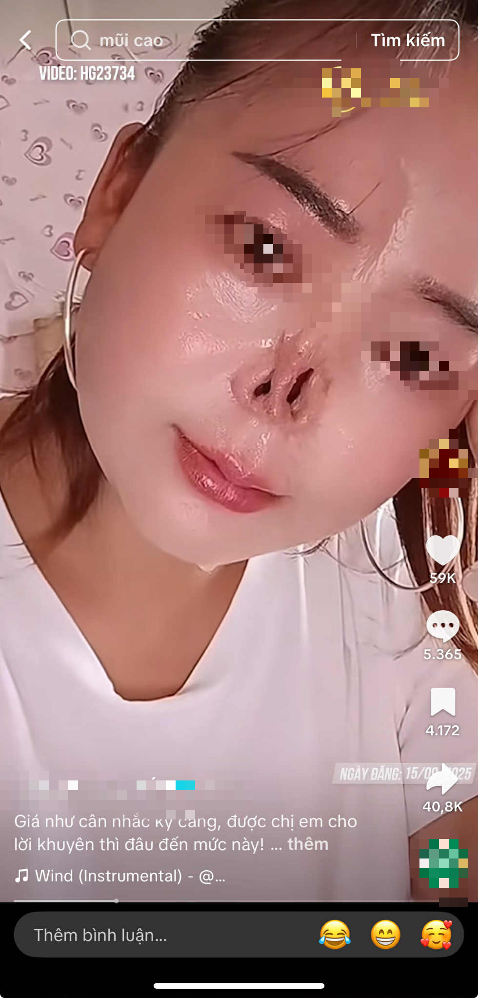 Đi sửa mũi cho thêm xinh, cô gái không ngờ mất luôn sống mũi: BS khuyến cáo 5 việc cần nhớ trước khi nâng mũi để tránh gặp họa- Ảnh 2. Đi sửa mũi cho thêm xinh, cô gái không ngờ mất luôn sống mũi: BS khuyến cáo 5 việc cần nhớ trước khi nâng mũi để tránh gặp họa- Ảnh 2.