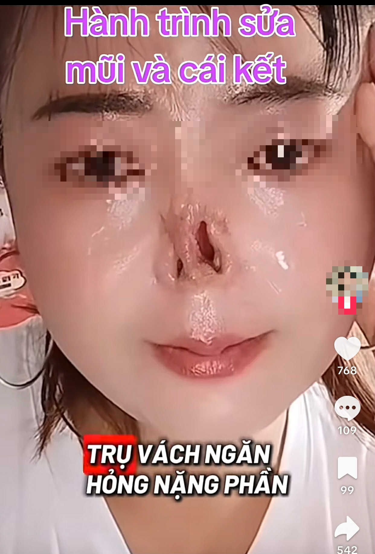 Đi sửa mũi cho thêm xinh, cô gái không ngờ mất luôn sống mũi: BS khuyến cáo 5 việc cần nhớ trước khi nâng mũi để tránh gặp họa- Ảnh 1. Đi sửa mũi cho thêm xinh, cô gái không ngờ mất luôn sống mũi: BS khuyến cáo 5 việc cần nhớ trước khi nâng mũi để tránh gặp họa- Ảnh 1.