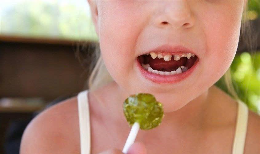Bánh kẹo ngọt có phải là "thủ phạm" gây sâu răng sữa sớm ở trẻ- Ảnh 1.