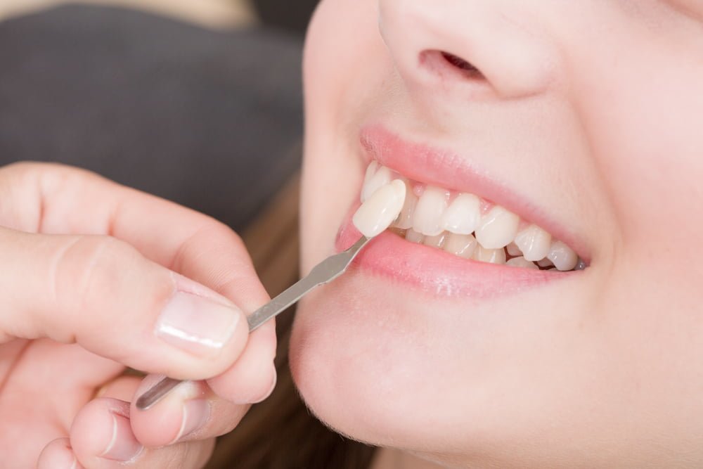 C&aacute;ch chăm s&oacute;c răng sau khi l&agrave;m veneer: B&iacute; quyết giữ nụ cười trắng s&aacute;ng l&acirc;u d&agrave;i- Ảnh 1.