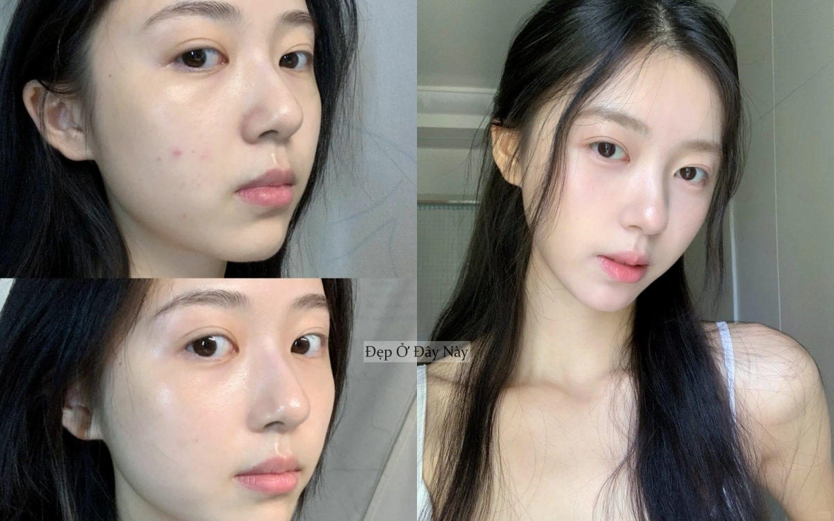 Từng bị mụn chi chít 2 bên má, cô nàng này đã áp dụng 4 bí quyết và làn da được cải thiện thấy rõ- Ảnh 1. Từng bị mụn chi chít 2 bên má, cô nàng này đã áp dụng 4 bí quyết và làn da được cải thiện thấy rõ- Ảnh 1.