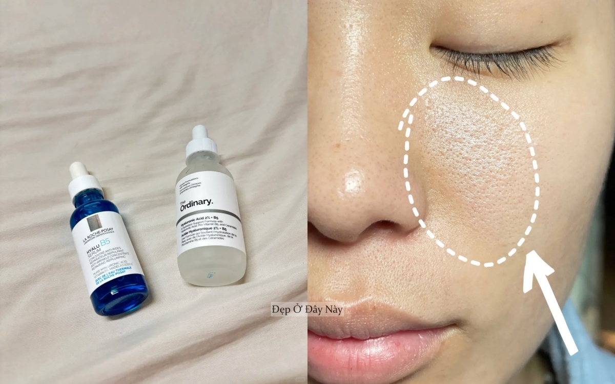 Ở tuổi 27, tôi đã tìm được "chân ái" trị da mụn, lỗ chân lông to- Ảnh 2.