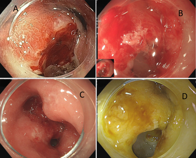 B&eacute; trai 12 tuổi xuất huyết ti&ecirc;u h&oacute;a, 3 th&aacute;ng nhập viện 2 lần v&igrave; loại vi khuẩn 70% d&acirc;n số Việt Nam nhiễm- Ảnh 1.