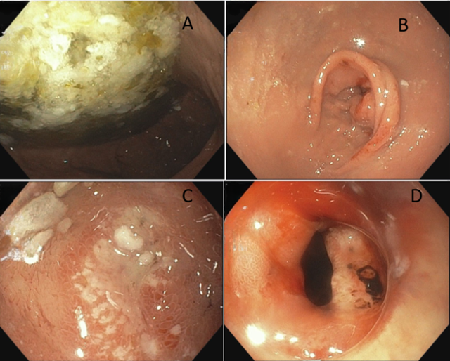 B&eacute; trai 12 tuổi xuất huyết ti&ecirc;u h&oacute;a, 3 th&aacute;ng nhập viện 2 lần v&igrave; loại vi khuẩn 70% d&acirc;n số Việt Nam nhiễm- Ảnh 2.