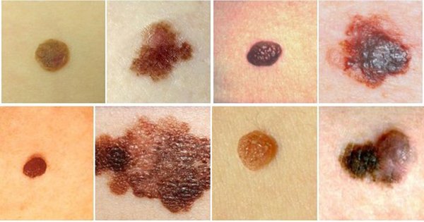 Tưởng nốt ruồi lộc trên mắt hoá ra mắc UNG THƯ DA, bác sĩ sửng sốt: Sai lầm chết người khi coi thường một ‘dấu chấm nhỏ’- Ảnh 2.