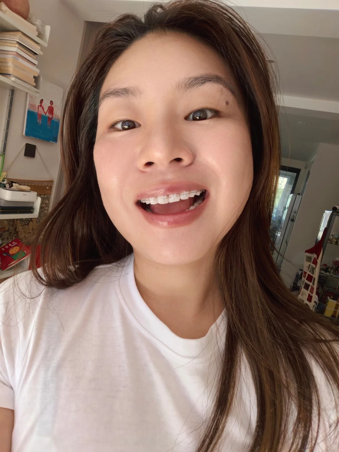 Niềng răng sứ và niềng trong suốt: Chọn gì để có nụ cười đẹp nhất?- Ảnh 2. Niềng răng sứ và niềng trong suốt: Chọn gì để có nụ cười đẹp nhất?- Ảnh 2.