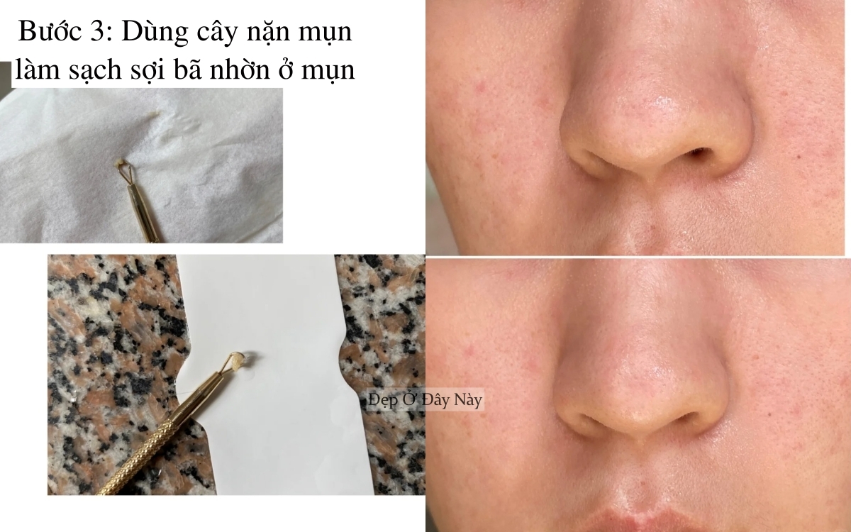 Ở tuổi 27, tôi học được cách làm sạch mụn đầu đen ở mũi hiệu quả, làm 1 lần là "nhẵn thín"- Ảnh 4. Ở tuổi 27, tôi học được cách làm sạch mụn đầu đen ở mũi hiệu quả, làm 1 lần là "nhẵn thín"- Ảnh 4.