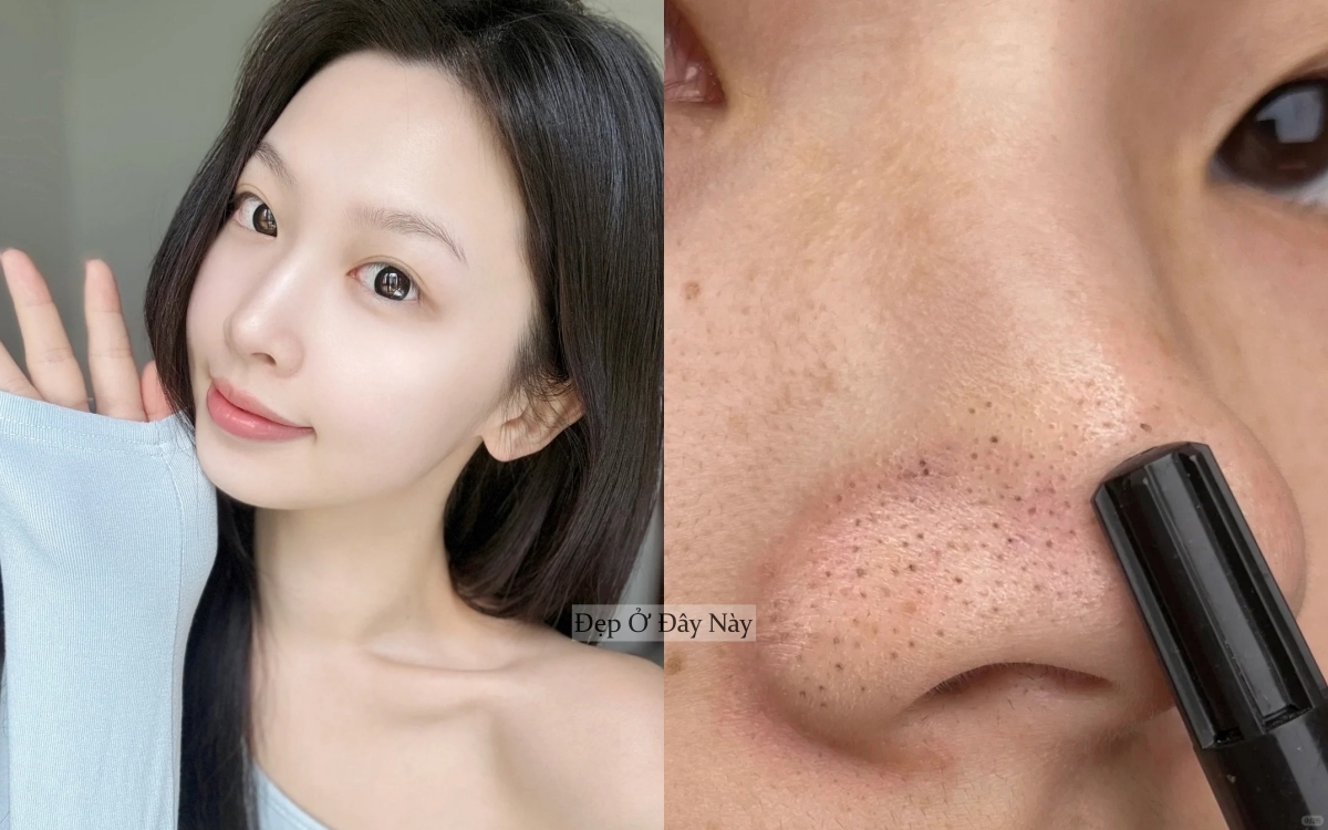 Ở tuổi 27, tôi học được cách làm sạch mụn đầu đen ở mũi hiệu quả, làm 1 lần là "nhẵn thín"- Ảnh 1. Ở tuổi 27, tôi học được cách làm sạch mụn đầu đen ở mũi hiệu quả, làm 1 lần là "nhẵn thín"- Ảnh 1.