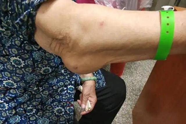 Bất kể nam hay nữ, nếu gặp phải 4 triệu chứng n&agrave;y ở c&aacute;nh tay, rất c&oacute; thể bạn bị ung thư: Dấu hiệu thứ 3 bị bỏ qua nhiều nhất- Ảnh 3.