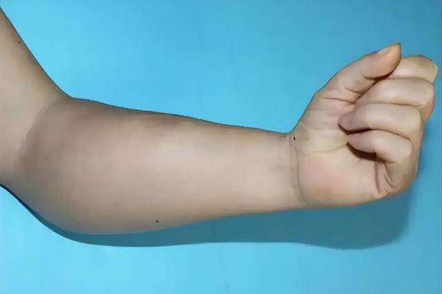 Bất kể nam hay nữ, nếu gặp phải 4 triệu chứng n&agrave;y ở c&aacute;nh tay, rất c&oacute; thể bạn bị ung thư: Dấu hiệu thứ 3 bị bỏ qua nhiều nhất- Ảnh 4.