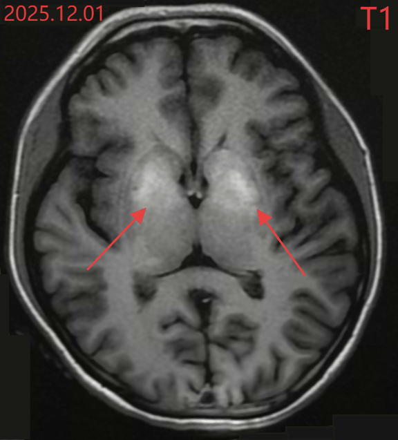 C&ocirc; g&aacute;i 20 tuổi mắc "bệnh lạ" nhảy m&uacute;a kh&ocirc;ng ngừng suốt 5 ng&agrave;y, nguồn gốc từ căn bệnh nhiều người mắc tại Việt Nam- Ảnh 1.