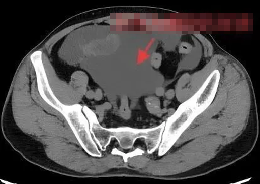 Nam thanh ni&ecirc;n vấp ng&atilde; vỡ b&agrave;ng quang, nguy&ecirc;n nh&acirc;n từ loại đồ uống y&ecirc;u th&iacute;ch của nhiều nam giới- Ảnh 1.
