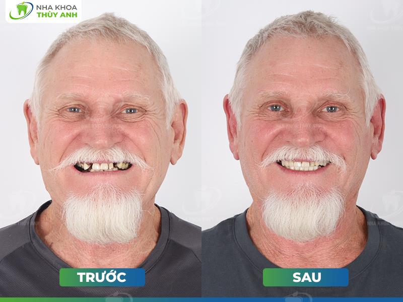 Nha khoa Th&ugrave;y Anh đ&oacute;n loạt kh&aacute;ch nước ngo&agrave;i tới Việt Nam l&agrave;m răng- Ảnh 3.