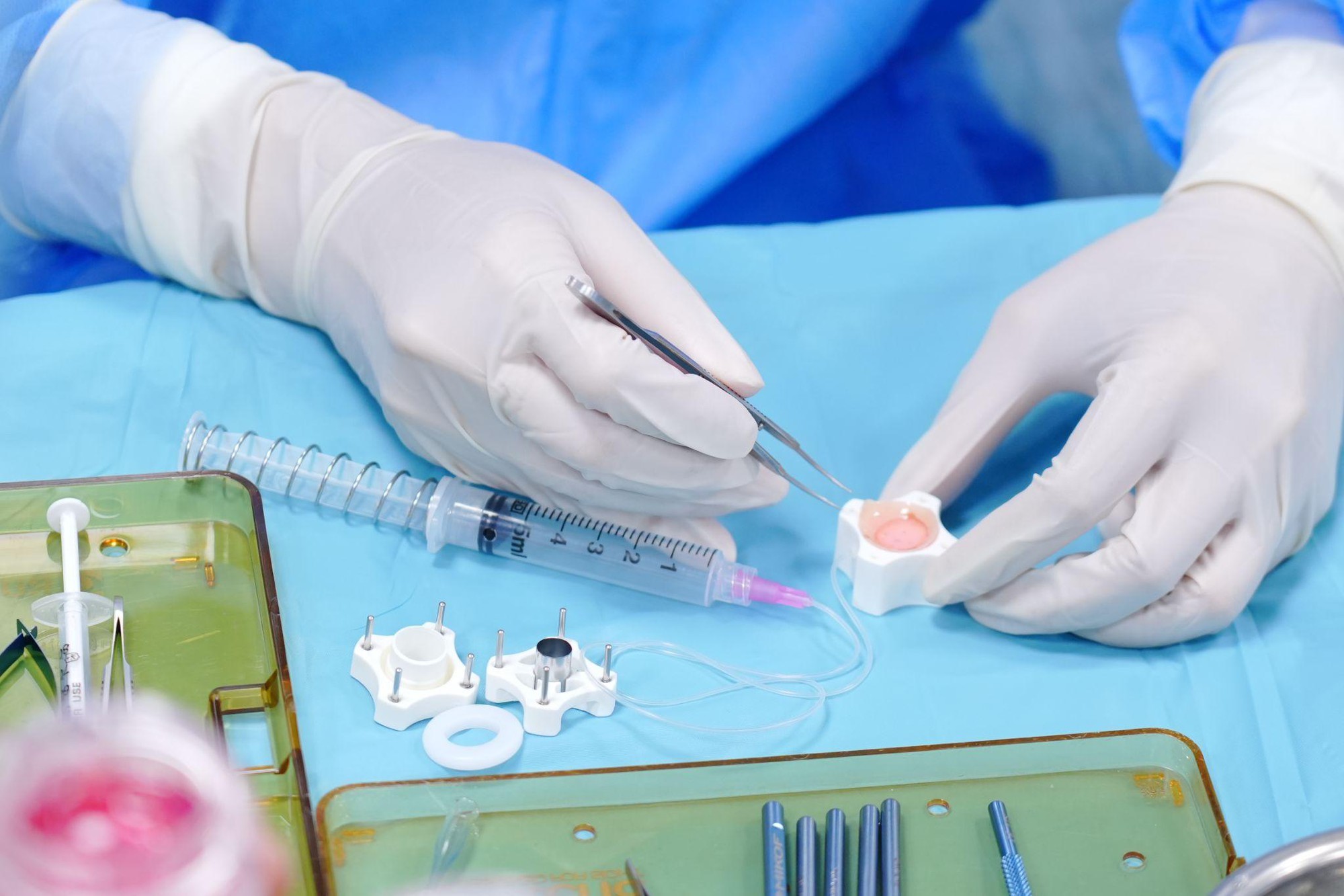 S&aacute;ng chế của nữ b&aacute;c sĩ Việt tạo bước tiến mới trong gh&eacute;p gi&aacute;c mạc- Ảnh 1.