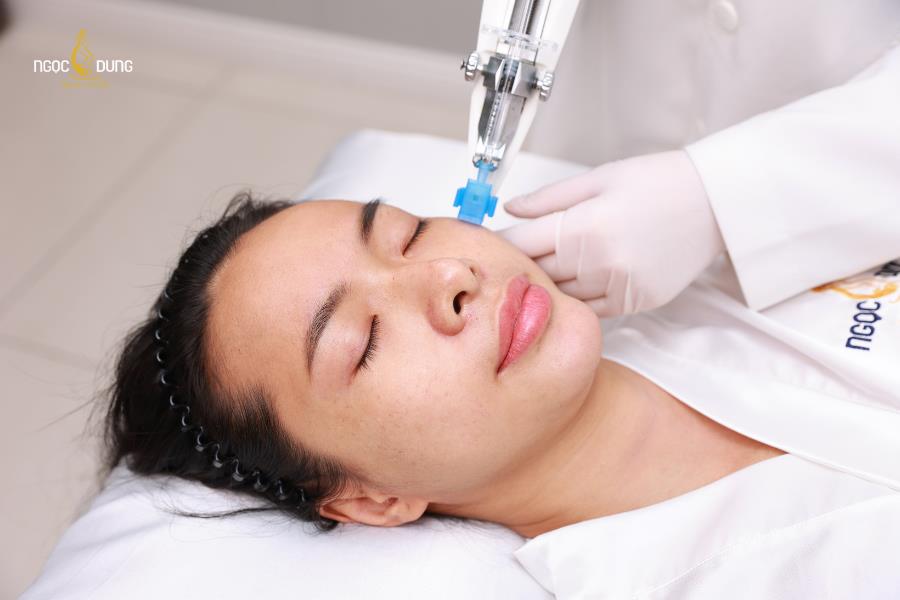 Laser se kh&iacute;t lỗ ch&acirc;n l&ocirc;ng: Giải ph&aacute;p cho l&agrave;n da mịn m&agrave;ng tức th&igrave;- Ảnh 3.