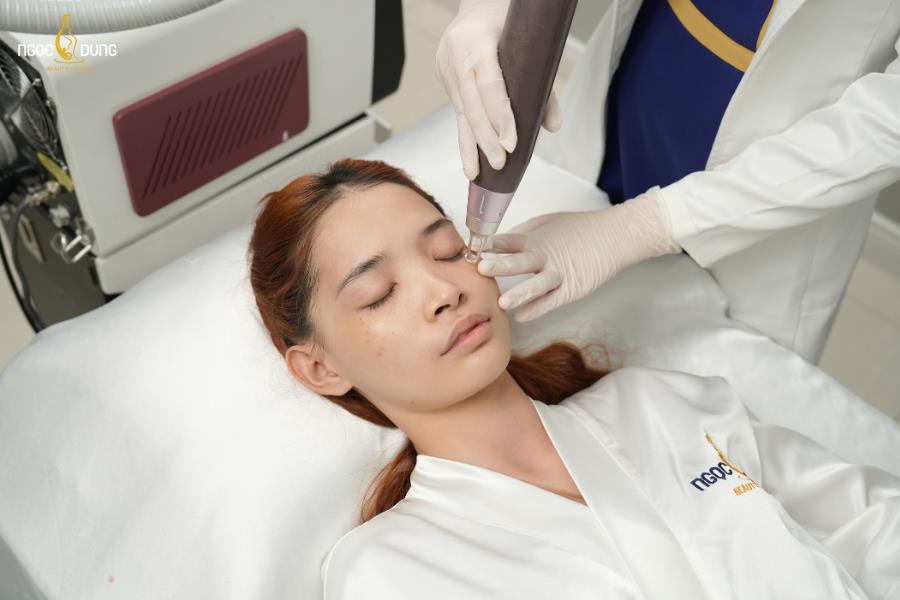 Laser se kh&iacute;t lỗ ch&acirc;n l&ocirc;ng: Giải ph&aacute;p cho l&agrave;n da mịn m&agrave;ng tức th&igrave;- Ảnh 4.