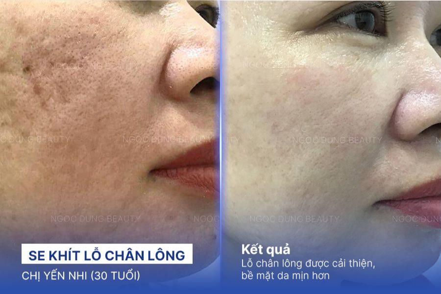 Laser se kh&iacute;t lỗ ch&acirc;n l&ocirc;ng: Giải ph&aacute;p cho l&agrave;n da mịn m&agrave;ng tức th&igrave;- Ảnh 5.