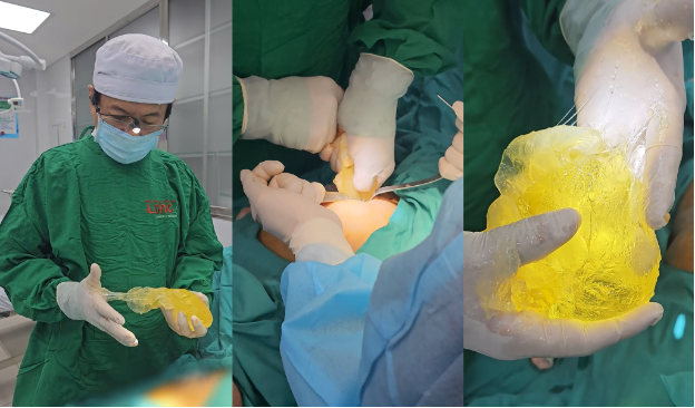 Nhập viện vì sốt nhẹ, nữ khách hàng bất ngờ phát hiện túi ngực 10 năm đã vỡ- Ảnh 2. Nhập viện vì sốt nhẹ, nữ khách hàng bất ngờ phát hiện túi ngực 10 năm đã vỡ- Ảnh 2.