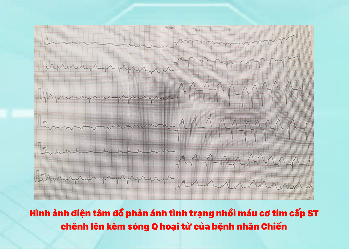 60 phút cứu sống bệnh nhân nhồi máu cơ tim giai đoạn hoại tử- Ảnh 1. 60 phút cứu sống bệnh nhân nhồi máu cơ tim giai đoạn hoại tử- Ảnh 1.