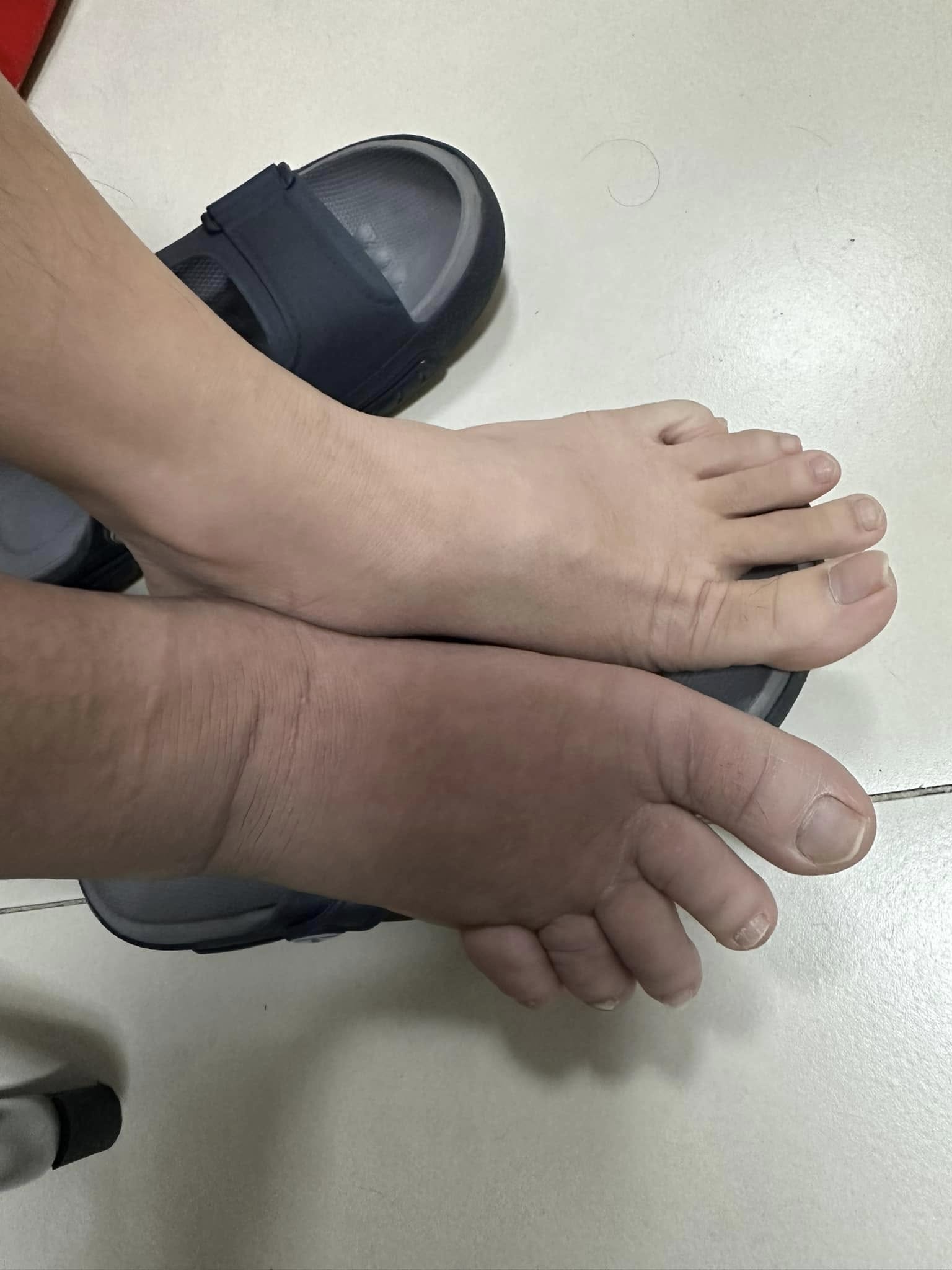 Chỉ sau cơn đau âm ỉ, người đàn ông tuyệt vọng vì bị "mất dần xương" và sự thật sau 3 năm đi tìm "thủ phạm"- Ảnh 1.