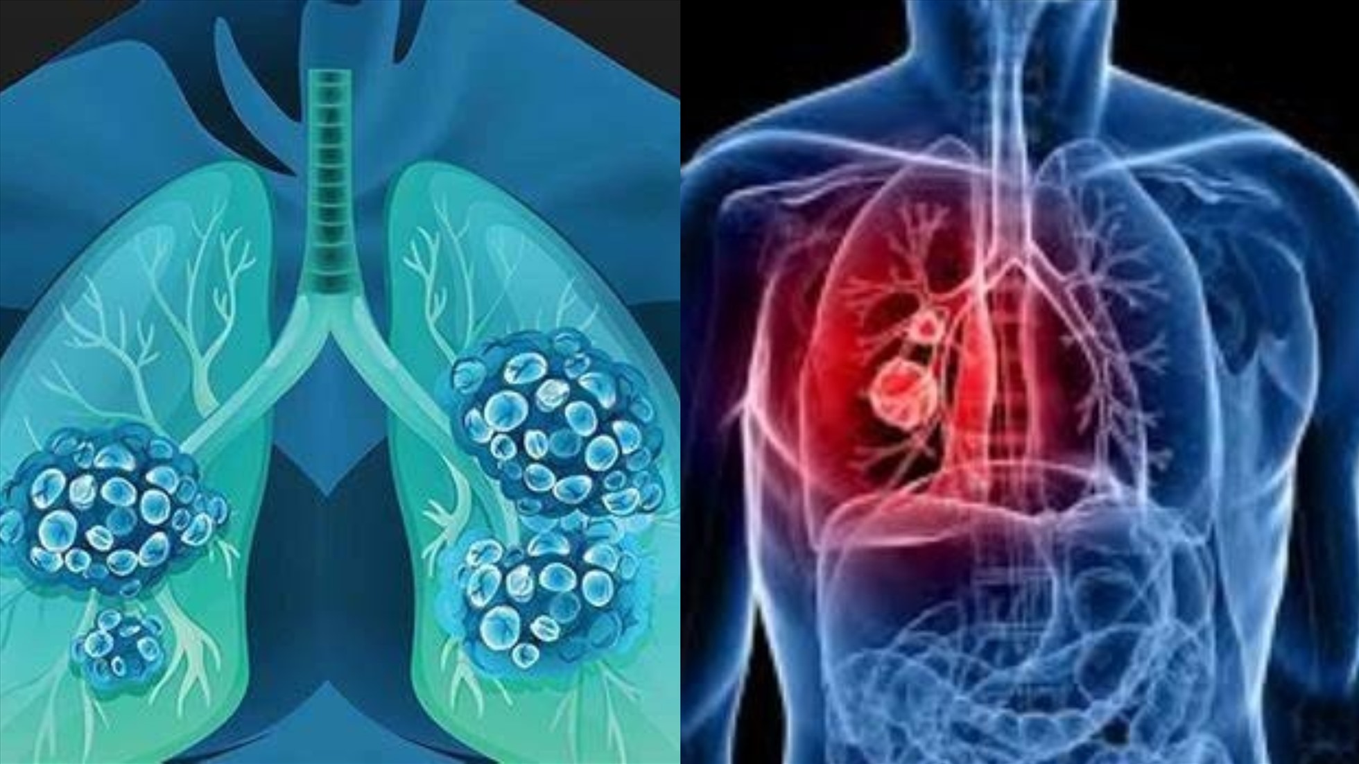 Thực phẩm siêu chế biến: Nguy cơ ung thư phổi cao hơn 41%?