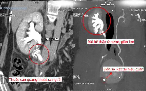 Kịp thời cứu bệnh nhân có sỏi kẹt niệu quản gây đa biến chứng- Ảnh 2. Kịp thời cứu bệnh nhân có sỏi kẹt niệu quản gây đa biến chứng- Ảnh 2.
