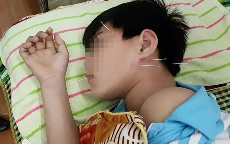 Bé 5 tuổi bị liệt nửa mặt đột ngột: Cảnh báo cha mẹ về căn bệnh trẻ có thể gặp do nằm quạt, điều hòa trong mùa hè- Ảnh 3. Bé 5 tuổi bị liệt nửa mặt đột ngột: Cảnh báo cha mẹ về căn bệnh trẻ có thể gặp do nằm quạt, điều hòa trong mùa hè- Ảnh 3.