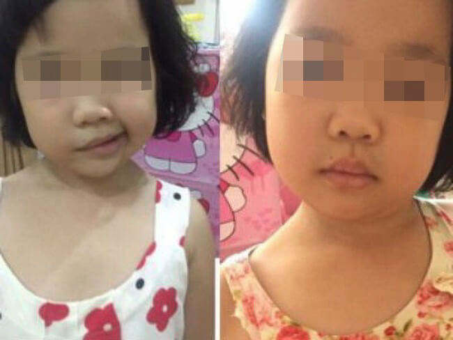 Bé 5 tuổi bị liệt nửa mặt đột ngột: Cảnh báo cha mẹ về căn bệnh trẻ có thể gặp do nằm quạt, điều hòa trong mùa hè- Ảnh 4. Bé 5 tuổi bị liệt nửa mặt đột ngột: Cảnh báo cha mẹ về căn bệnh trẻ có thể gặp do nằm quạt, điều hòa trong mùa hè- Ảnh 4.