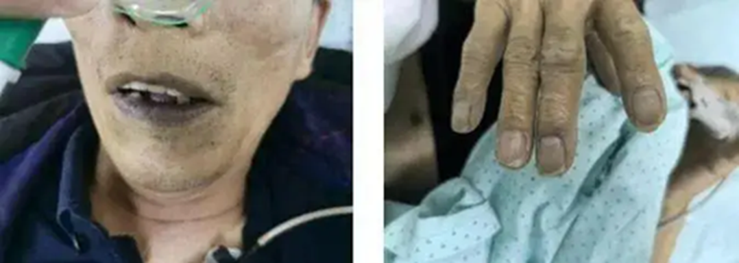 Nam thanh niên 25 tuổi tiểu ra "nước xanh kỳ quái”, hôn mê sâu vì trúng kịch độc thường thấy trong món ăn nhiều người Việt mê- Ảnh 2. Nam thanh niên 25 tuổi tiểu ra "nước xanh kỳ quái”, hôn mê sâu vì trúng kịch độc thường thấy trong món ăn nhiều người Việt mê- Ảnh 2.