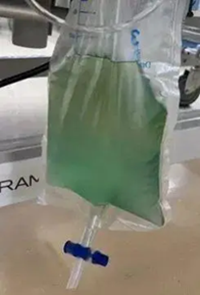 Nam thanh niên 25 tuổi tiểu ra "nước xanh kỳ quái”, hôn mê sâu vì trúng kịch độc thường thấy trong món ăn nhiều người Việt mê- Ảnh 1. Nam thanh niên 25 tuổi tiểu ra "nước xanh kỳ quái”, hôn mê sâu vì trúng kịch độc thường thấy trong món ăn nhiều người Việt mê- Ảnh 1.
