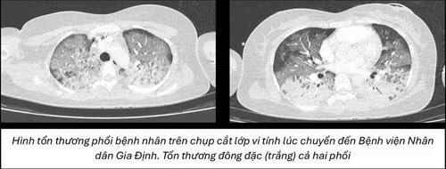 Cô gái 28 tuổi sốc phản vệ nguy kịch sau nâng mũi, được cứu sống nhờ ECMO- Ảnh 2. Cô gái 28 tuổi sốc phản vệ nguy kịch sau nâng mũi, được cứu sống nhờ ECMO- Ảnh 2.