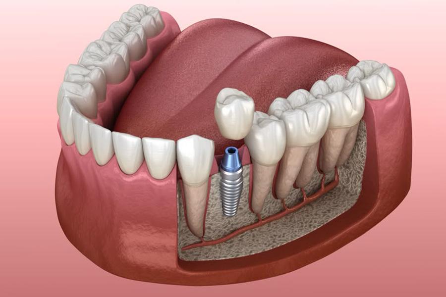 Tiêu chân răng là gì? Phân loại và cách điều trị- Ảnh 3. Tiêu chân răng là gì? Phân loại và cách điều trị- Ảnh 3.