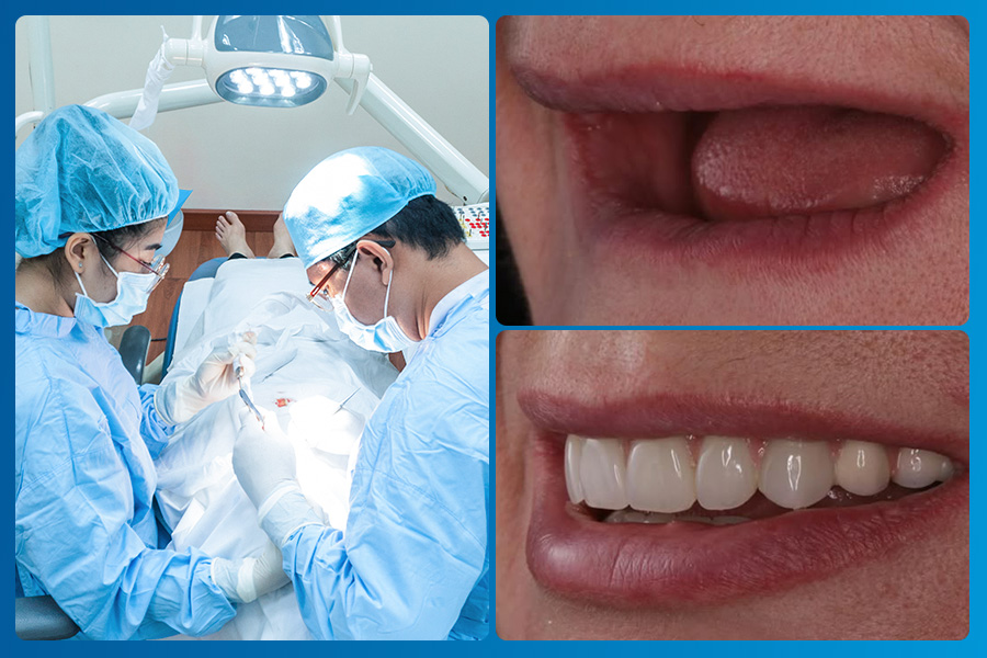 Khuôn mặt lệch, nếp nhăn sớm có thể bắt nguồn từ việc mất răng – Đừng xem nhẹ!- Ảnh 3. Khuôn mặt lệch, nếp nhăn sớm có thể bắt nguồn từ việc mất răng – Đừng xem nhẹ!- Ảnh 3.