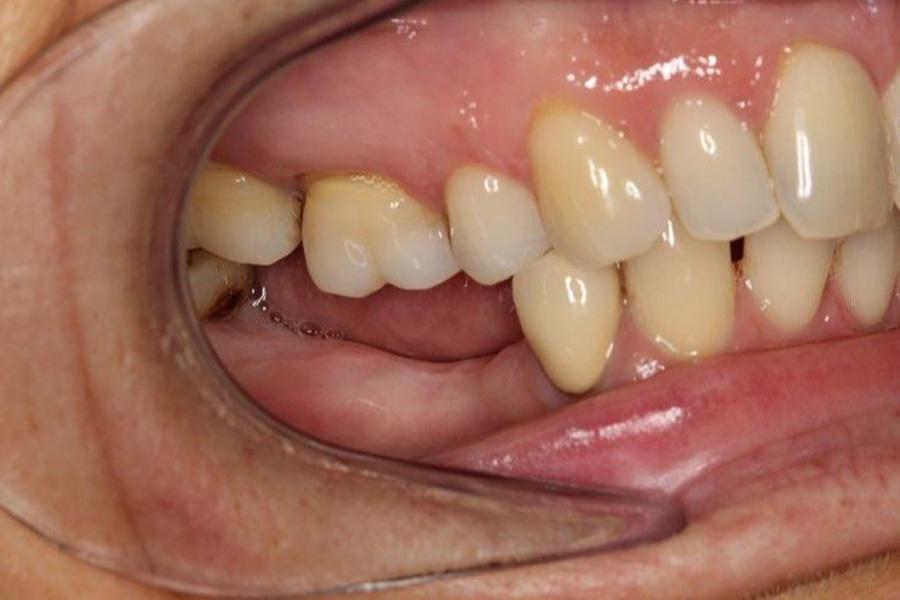 Tiêu chân răng là gì? Phân loại và cách điều trị- Ảnh 1. Tiêu chân răng là gì? Phân loại và cách điều trị- Ảnh 1.
