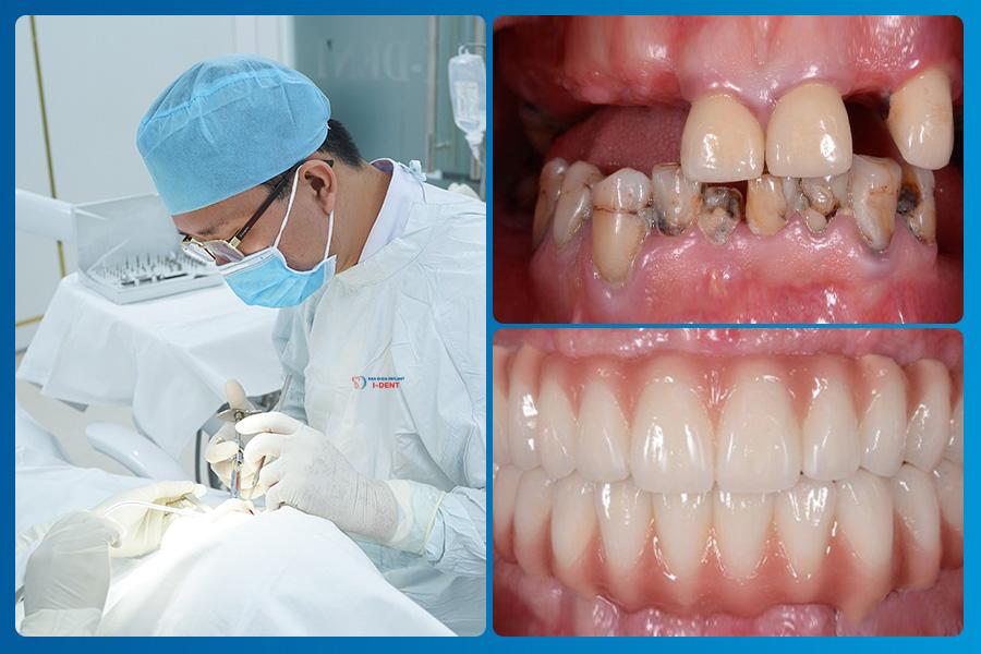 Tiêu chân răng là gì? Phân loại và cách điều trị- Ảnh 4. Tiêu chân răng là gì? Phân loại và cách điều trị- Ảnh 4.