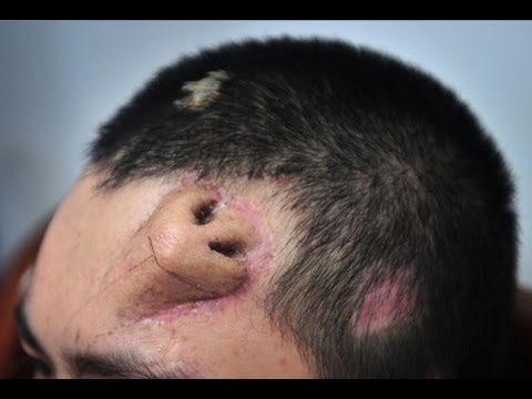 Không phải ảnh lỗi của AI, người đàn ông này đã thực sự mọc một chiếc mũi trên trán: Đó là "tác phẩm" của các bác sĩ Trung Quốc- Ảnh 5. Không phải ảnh lỗi của AI, người đàn ông này đã thực sự mọc một chiếc mũi trên trán: Đó là "tác phẩm" của các bác sĩ Trung Quốc- Ảnh 5.