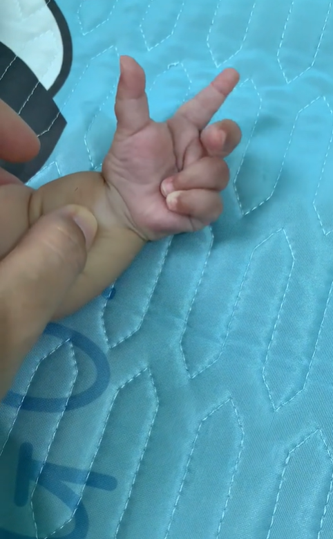 Thấy bàn tay bụ bẫm của con có 1 "chi tiết lạ", mẹ Việt lên mạng mới biết con có "dấu hiệu dị tật", cần đến khám bác sĩ Nhi gấp- Ảnh 2.