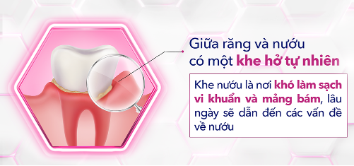 Cảnh báo: Nướu yếu làm răng hư hại – Chăm sóc ngay trước khi quá muộn- Ảnh 2. Cảnh báo: Nướu yếu làm răng hư hại – Chăm sóc ngay trước khi quá muộn- Ảnh 2.