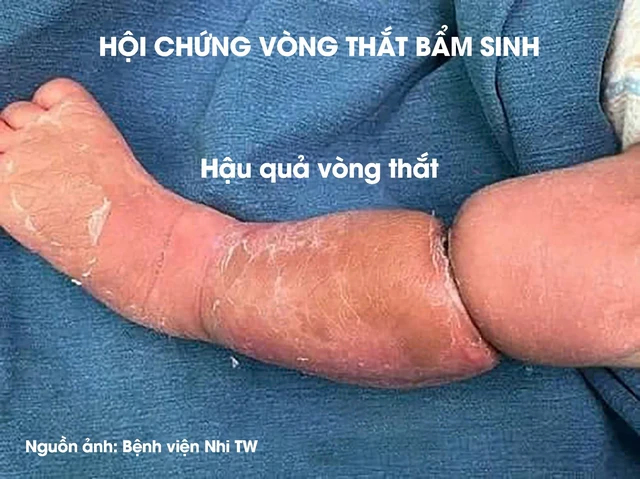 Thấy bàn tay bụ bẫm của con có 1 "chi tiết lạ", mẹ Việt lên mạng mới biết con có "dấu hiệu dị tật", cần đến khám bác sĩ Nhi gấp- Ảnh 4.