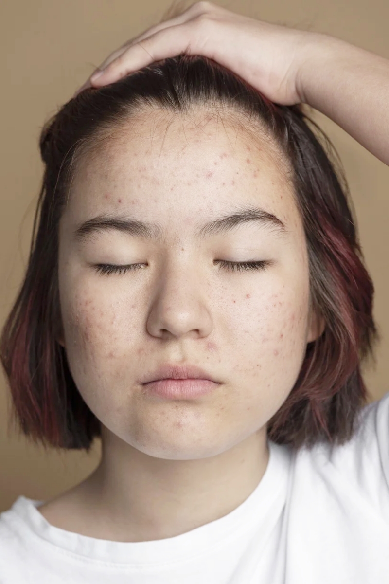 Hướng dẫn dùng Retinol đúng cách, da bị nổi mụn khi dùng có phải là điều bình thường?- Ảnh 1. Hướng dẫn dùng Retinol đúng cách, da bị nổi mụn khi dùng có phải là điều bình thường?- Ảnh 1.