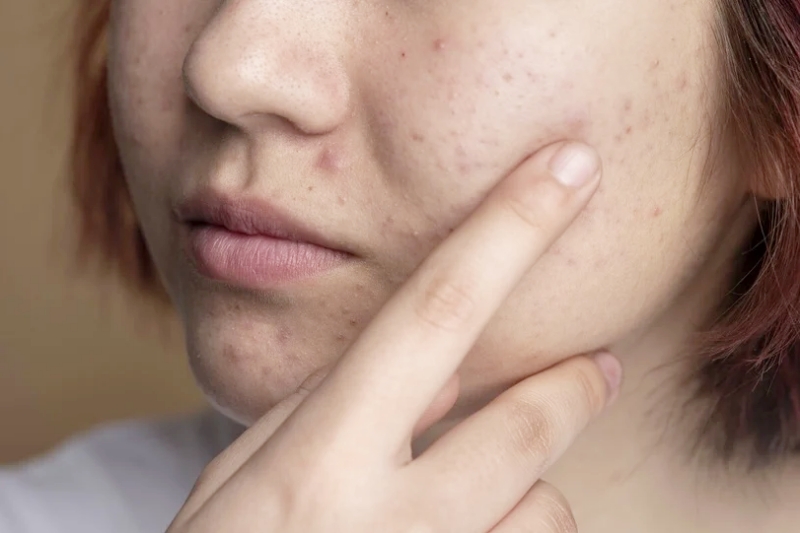 Hướng dẫn dùng Retinol đúng cách, da bị nổi mụn khi dùng có phải là điều bình thường?- Ảnh 2. Hướng dẫn dùng Retinol đúng cách, da bị nổi mụn khi dùng có phải là điều bình thường?- Ảnh 2.