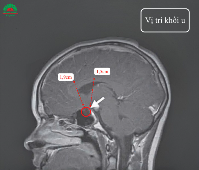 Tầm soát dậy thì sớm, bé gái bất ngờ phát hiện khối u não- Ảnh 2.