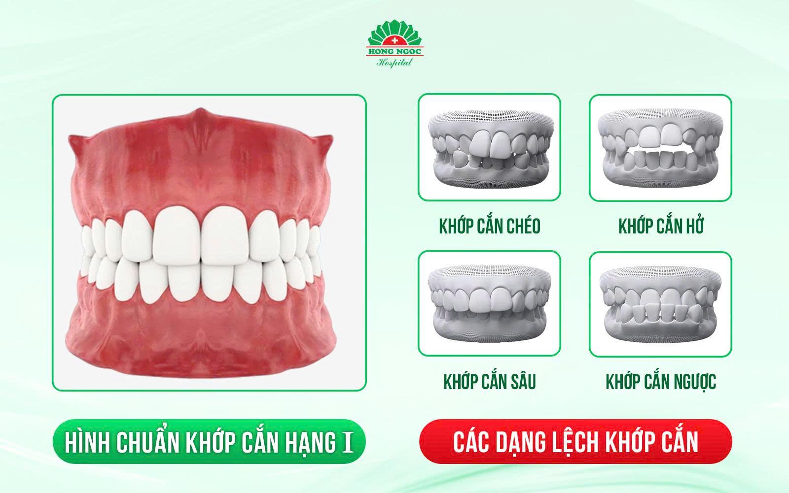 Niềng răng đẹp thôi chưa đủ - Cần chuẩn khớp cắn hạng I và bền vững lâu dài- Ảnh 2.