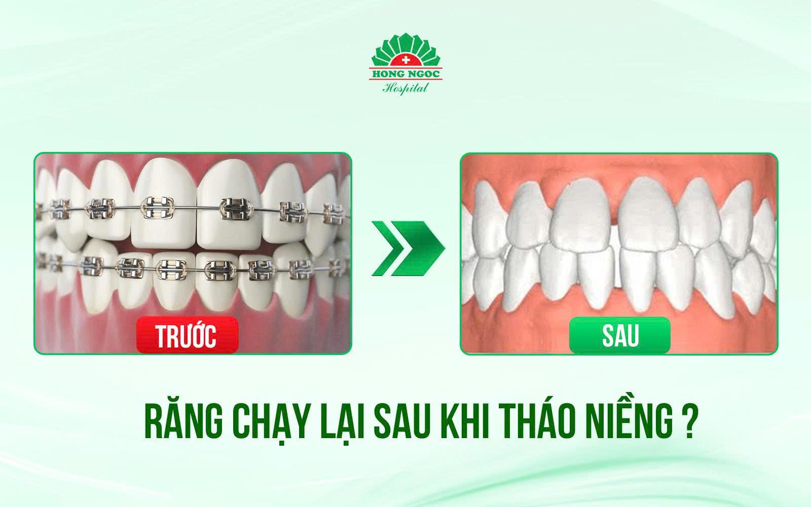 Niềng răng đẹp thôi chưa đủ - Cần chuẩn khớp cắn hạng I và bền vững lâu dài- Ảnh 3.