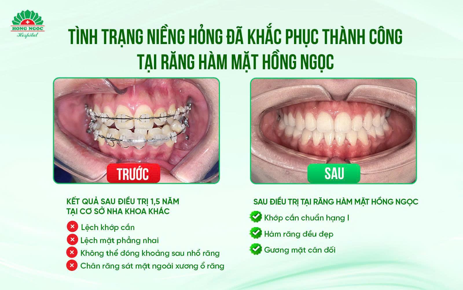 Niềng răng đẹp thôi chưa đủ - Cần chuẩn khớp cắn hạng I và bền vững lâu dài- Ảnh 5.