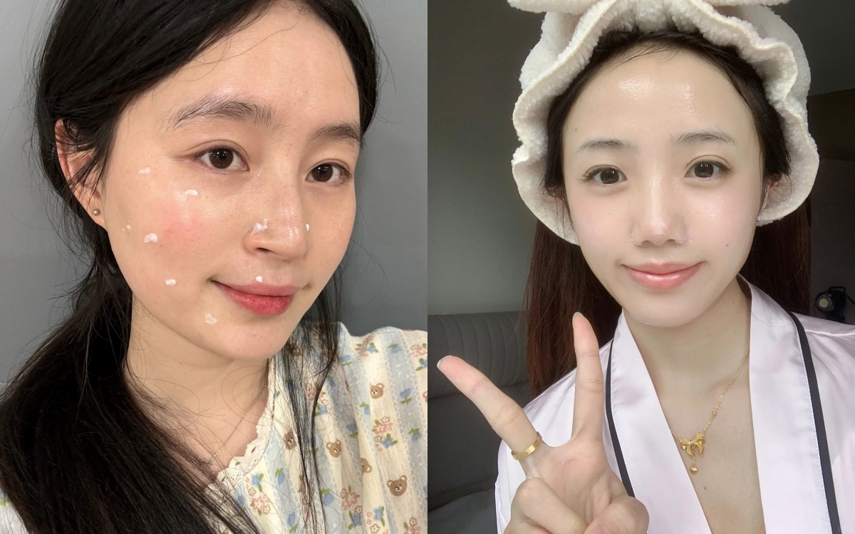 Làn da li ti mụn của tôi đã được cải thiện hoàn toàn nhờ 5 chiêu đơn giản- Ảnh 1. Làn da li ti mụn của tôi đã được cải thiện hoàn toàn nhờ 5 chiêu đơn giản- Ảnh 1.